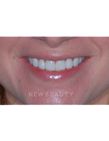 Dr. Guy Lewis Veneers - After