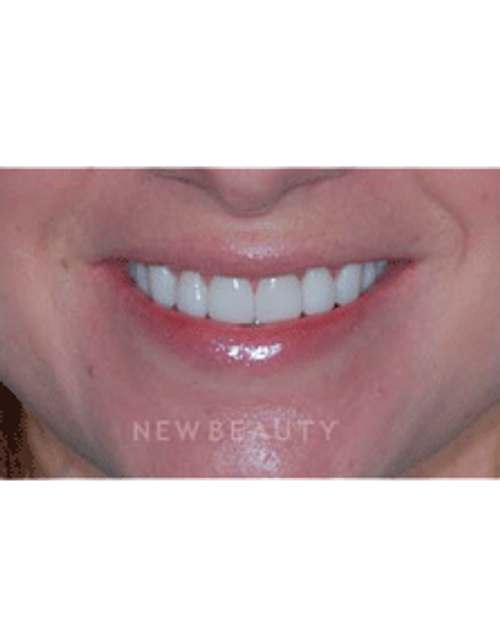 Dr. Guy Lewis Veneers - After