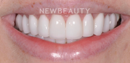 Dr. Salvator La Mastra – Smile Makeover – 46107351 - After