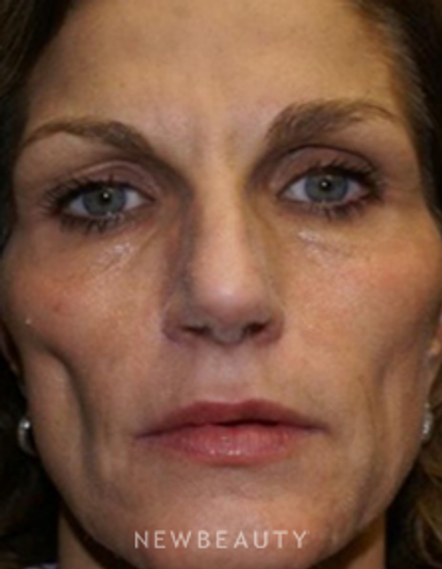 Dr. Marina Peredo - Sculptra - Before