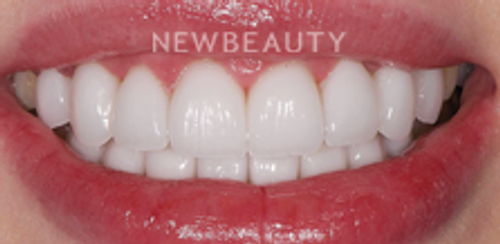 Dr. Salvator La Mastra - Smile Makeover -46106819 - After