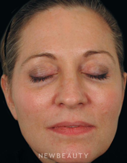 Dr. Gilly Munavalli Lasers - After