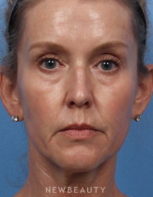 Dr. Kelly Bomer - Liquid Facelift - Before