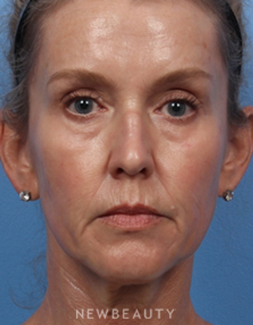 Dr. Kelly Bomer - Liquid Facelift - Before