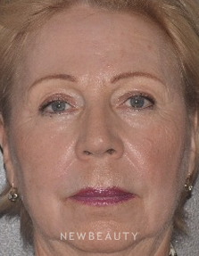 Dr. Roman Rayham - Laser Skin Resurfacing - After