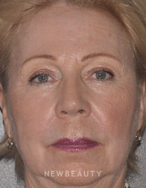Dr. Roman Rayham - Laser Skin Resurfacing - After