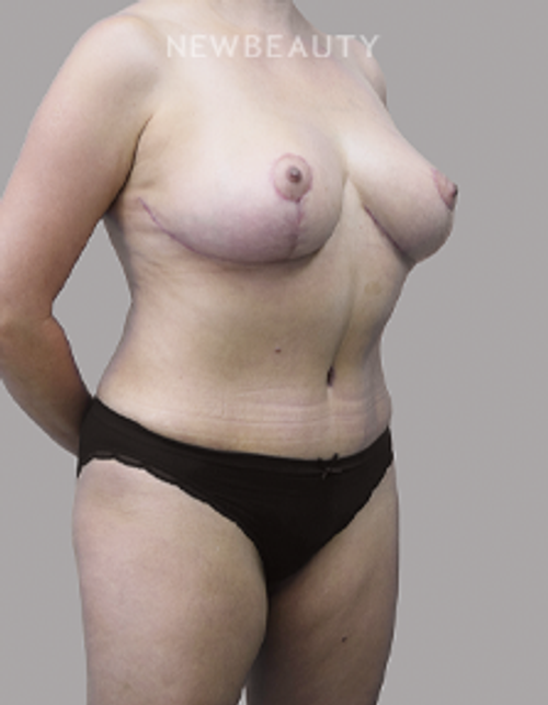 Dr. Olga Bachilo - Mommy Makeover - 28650984 - After