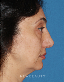 Dr. Konstantin Vasyukevich, Traditional Facelift - Before
