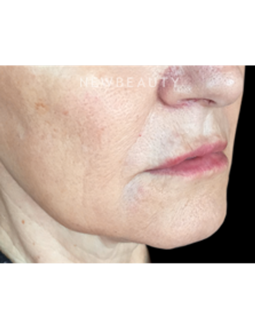 Dr. Kally Papantoniou - Liquid Facelift - After