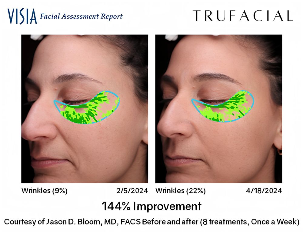 true facial under-eyes