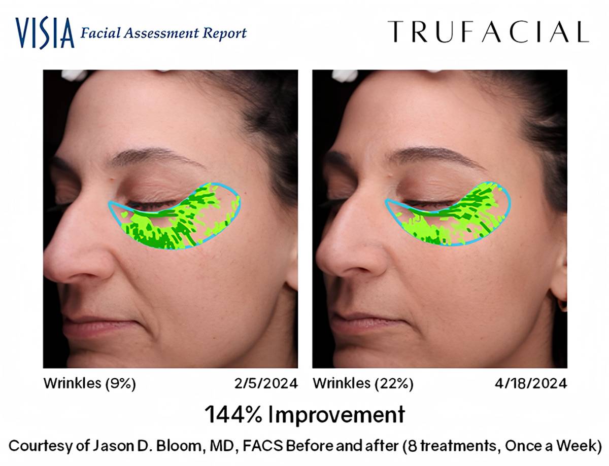true facial under-eyes