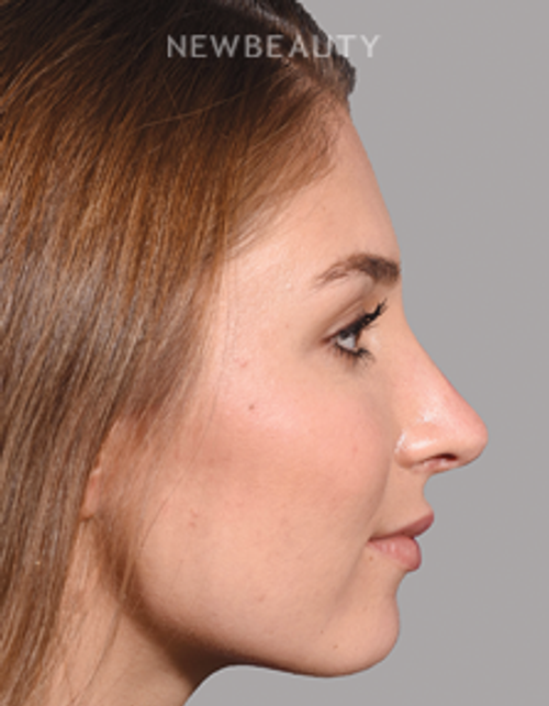Sam P. Most, M.D. - 21009776 - Rhinoplasty - After