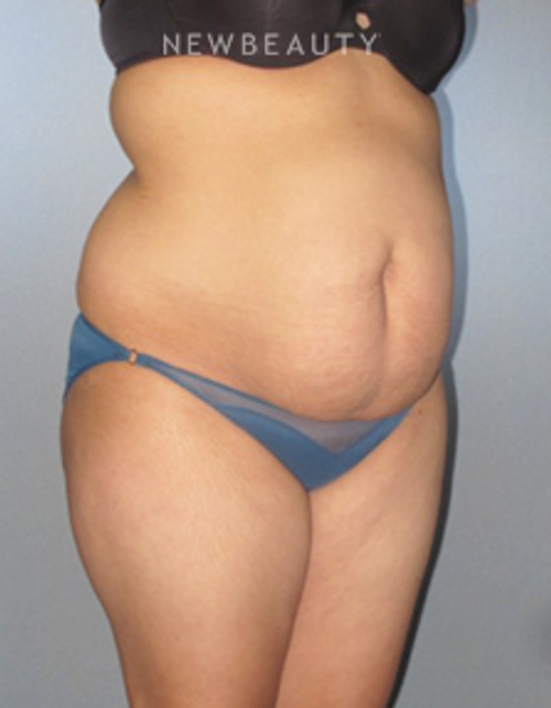 Dr. German Newall - Slimmer Profile - Before