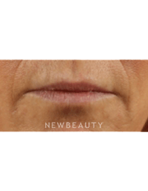 Dr. Marina Peredo Lip Augmentation - Before