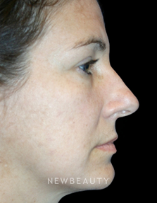 Dr. Kelly Bomer Rhinoplasty - Before