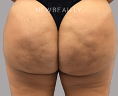 Drs. Elias - Cellulite Treatment - 17150176 - After