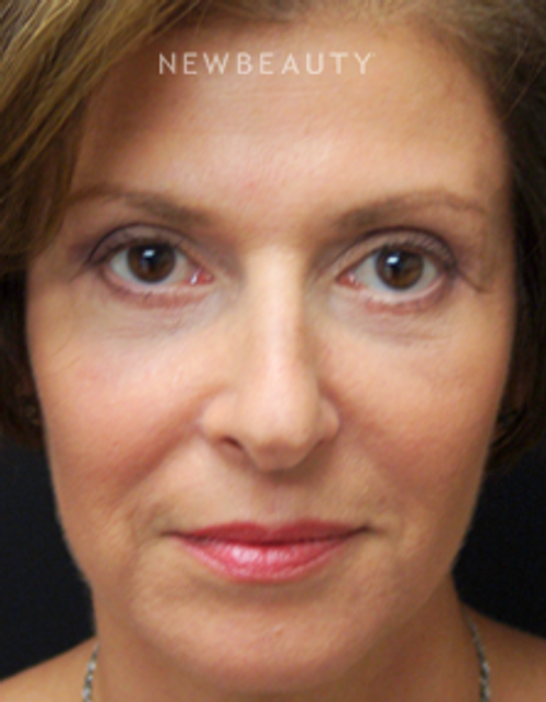 Dr. Mokhtar Asaadi - Blepharoplasties - After