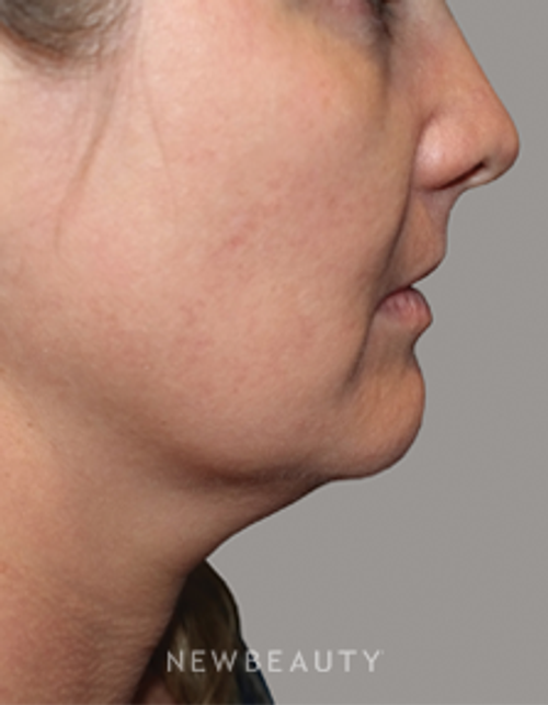 Dr. Bryan W. Gawley - No Downtime - Before