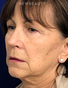 Dr. Dilip Madnani - Liquid Facelift - Before