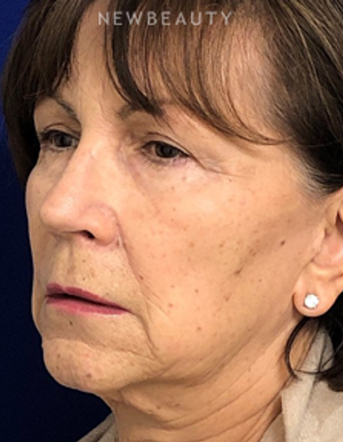 Dr. Dilip Madnani - Liquid Facelift - Before