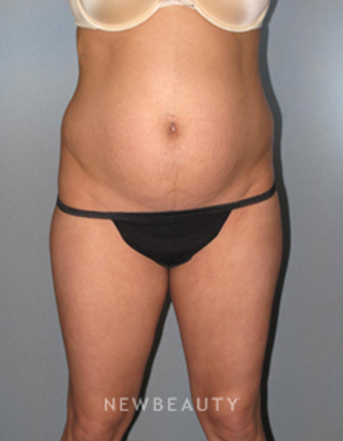 Dr. German Newall - Desired Contours - Before