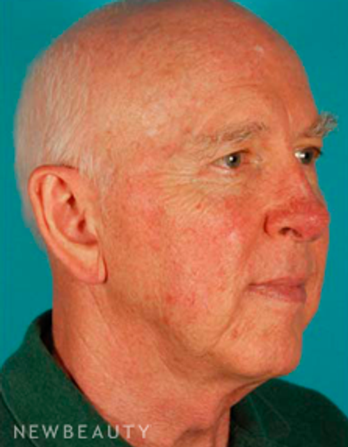 Dr. David Kim Facelift - Before