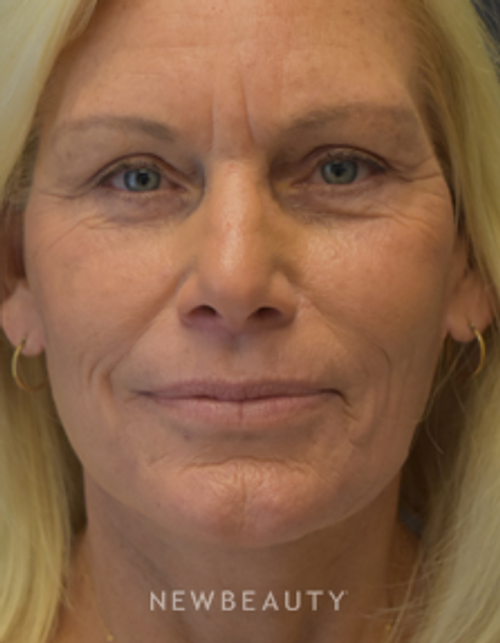 Drs. Lieberman & Parikh - Facelift - After