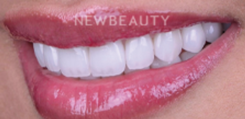 Dr. Husam Almunajed - Gum Lift & Veneers - 32922683 - After