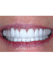 Dr. Guy M. Lewis, Smile Makeover - After