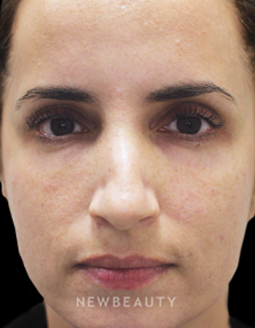 Dr. Gilly Munavalli - Injectables and Fillers - After