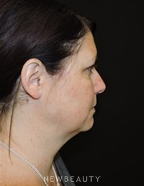 Dr. Joel Schlessinger - Kybella - After