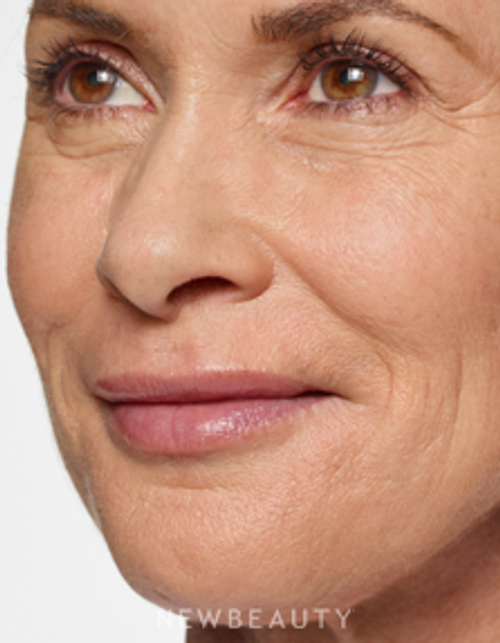 Dr. Marina Peredo - Lip Enhancement - After
