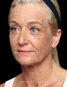 Dr. Kenneth Beer - Liquid Facelift - Before