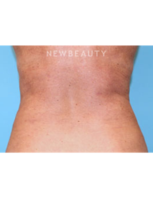 Dr. Christine Hamori - Tummy Tuck - After