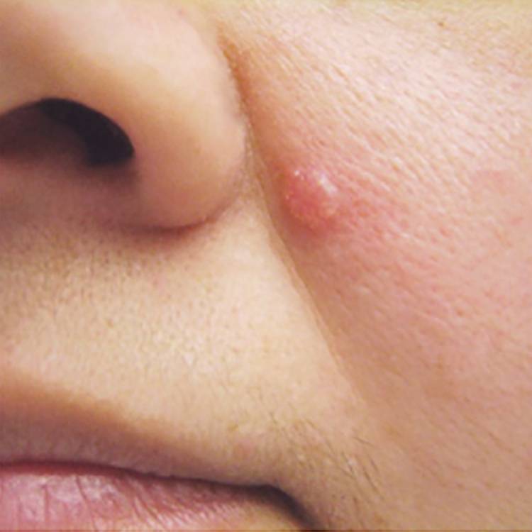skin cancer on face