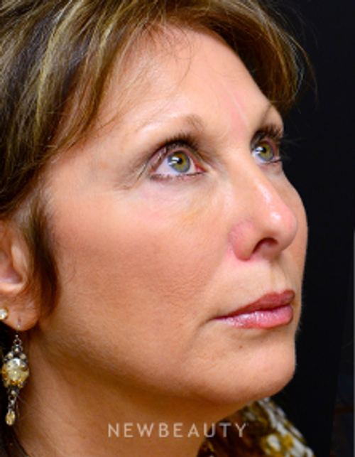 Dr. Mokhtar Asaadi Injectables & FIllers - After