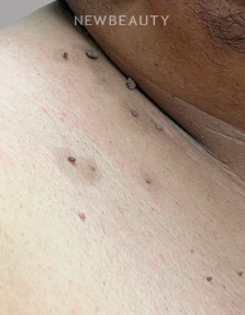 Dr. Anna Chacon - Skin Tags/Wart - 34279643 - After