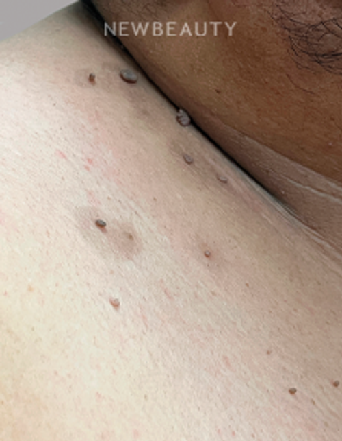 Dr. Anna Chacon - Skin Tags/Wart - 34279643 - After