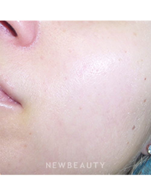 Dr. Kally Papantoniou - Acne Treatment - After