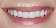 Dr. Nathan Hoffman - Invisalign - After
