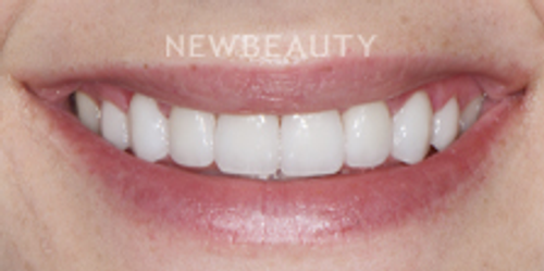 Dr. Nathan Hoffman - Invisalign - After