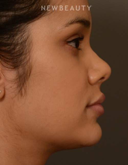 Dr. David Kim - Rhinoplasty - Before