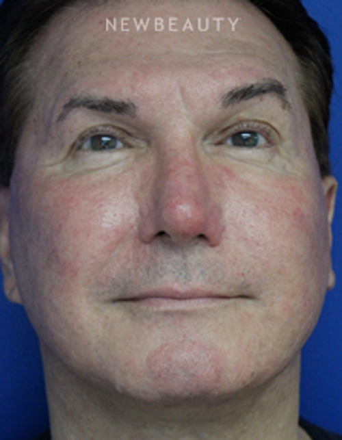 Dr. Joseph Russo - Natural-Looking Results (Face EBG) - After