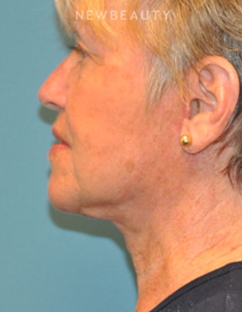 Dr. Alan Durkin - Limited Incision Facelift - After