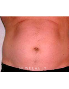 Dr. Roman Rayham - Sculpted Look - Before