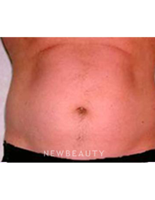 Dr. Roman Rayham - Sculpted Look - Before