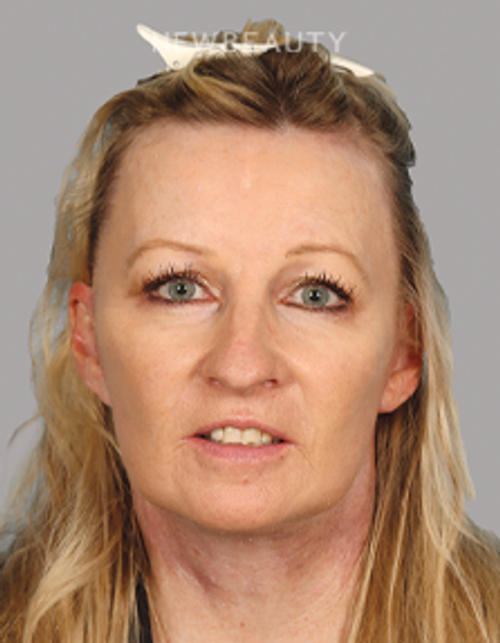 Dr. Mahabir - Facelift - 20637984 - After