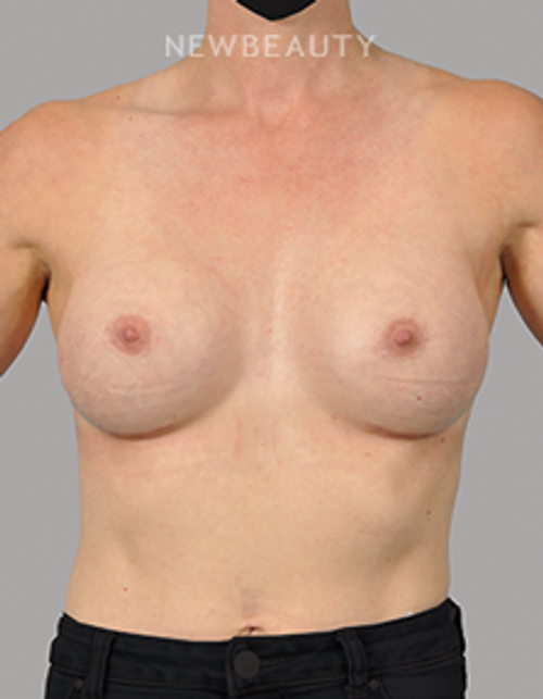 Dr. David Alfonso - Volume Boost - 20902719 - After