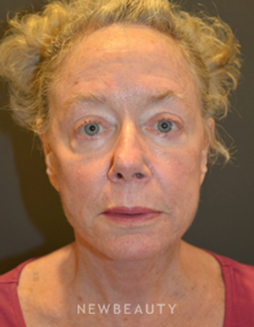 Dr. Aviva Preminger - Facelift - After