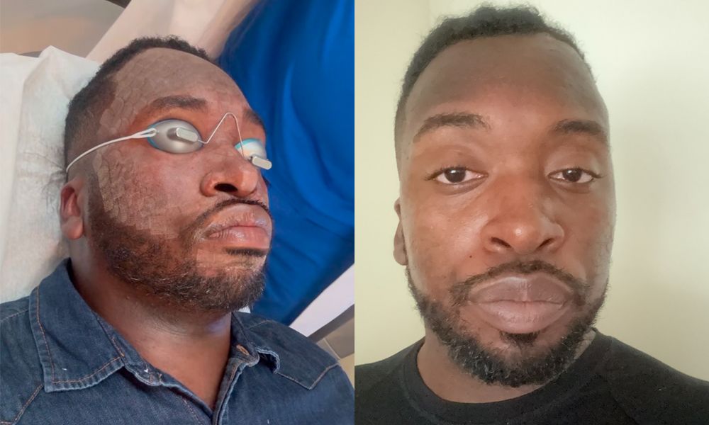 Man before and after UltraClear laser facial